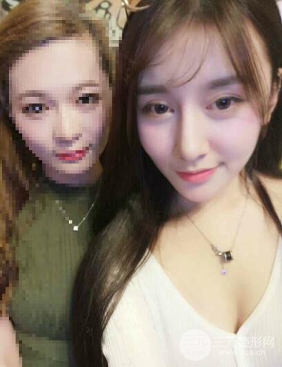 深圳源美做隆鼻失敗修復價格案例