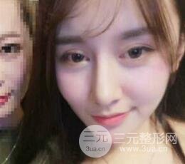 深圳源美做隆鼻失敗修復(fù)價(jià)格案例