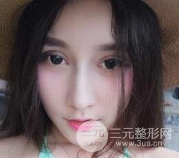 深圳源美做隆鼻失敗修復(fù)價(jià)格案例