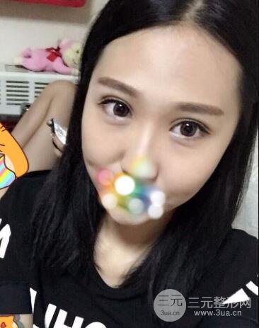 切開雙眼皮無疤痕增生果好圖片案例分享