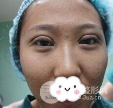 切開雙眼皮無疤痕增生果好圖片案例分享