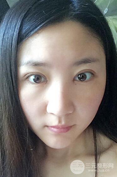 單眼皮割雙眼皮成功案例圖片