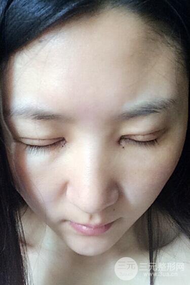 單眼皮割雙眼皮成功案例圖片