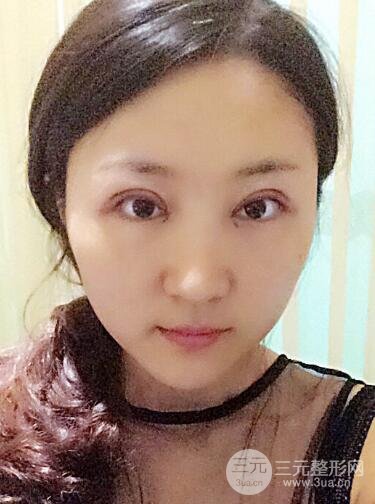 單眼皮割雙眼皮成功案例圖片