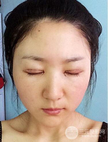 單眼皮割雙眼皮成功案例圖片