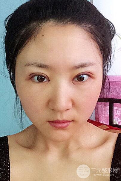 單眼皮割雙眼皮成功案例圖片