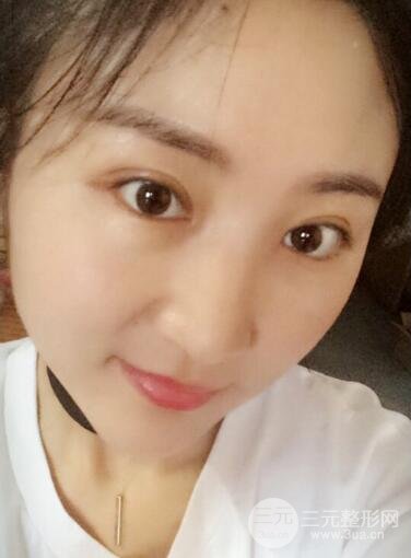 單眼皮割雙眼皮成功案例圖片