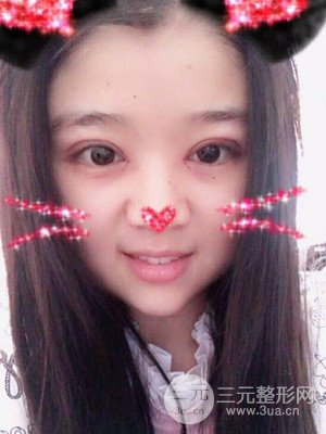 切開雙眼皮+開內(nèi)眼角真實案例，并附上前后對比圖片