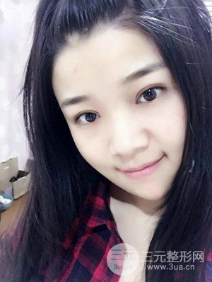 切開雙眼皮+開內(nèi)眼角真實案例，并附上前后對比圖片