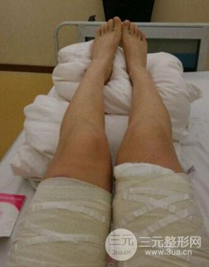 大腿抽脂案例 大腿抽脂前后對比圖