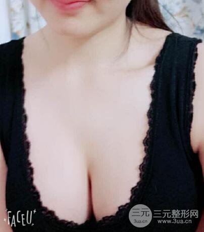 本人自體抽脂隆胸手術(shù)果很好價(jià)格案例