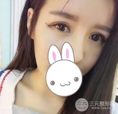 割雙眼皮失敗變幾層眼皮成功修復價格和案例分享