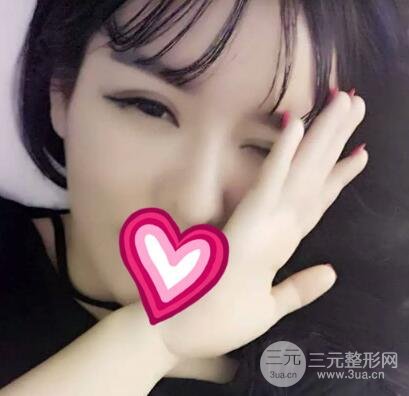 割雙眼皮失敗變幾層眼皮成功修復價格和案例分享