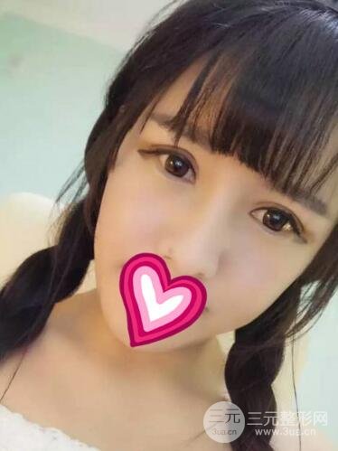 割雙眼皮失敗變幾層眼皮成功修復價格和案例分享