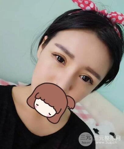 割雙眼皮失敗變幾層眼皮成功修復價格和案例分享