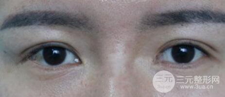 割雙眼皮失敗變幾層眼皮成功修復價格和案例分享