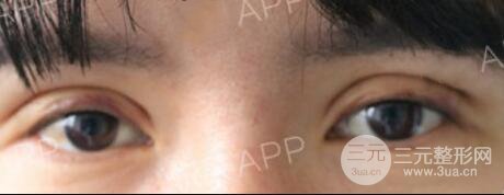 割雙眼皮失敗變幾層眼皮成功修復價格和案例分享