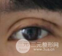 割雙眼皮失敗變幾層眼皮成功修復(fù)價格和案例分享