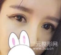 割雙眼皮失敗變幾層眼皮成功修復(fù)價格和案例分享