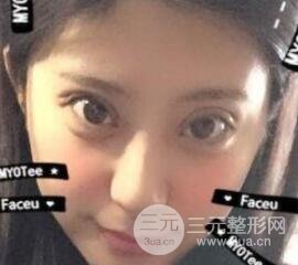 成都嬌點李競割雙眼皮價格和案例