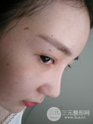 隆鼻整形案例日記分享：附上前后對比圖片