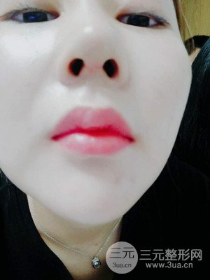 隆鼻整形案例日記分享：附上前后對比圖片