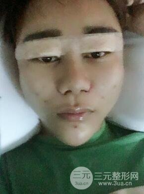 切開雙眼皮+自體脂肪填充全臉真實(shí)案例分享，并附上前后對(duì)比圖片~