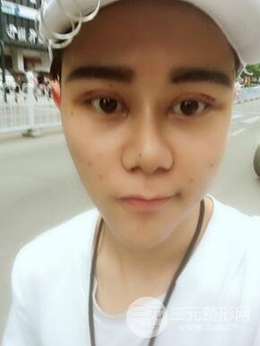 切開雙眼皮+自體脂肪填充全臉真實(shí)案例分享，并附上前后對(duì)比圖片~