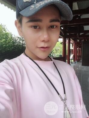 切開雙眼皮+自體脂肪填充全臉真實(shí)案例分享，并附上前后對(duì)比圖片~