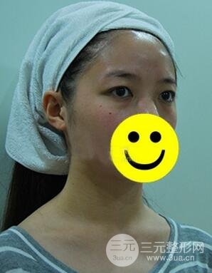 內(nèi)切祛眼袋手術(shù)真實(shí)案例，并附上前后對(duì)比圖片