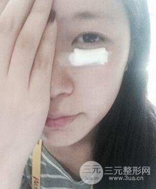 內(nèi)切祛眼袋手術(shù)真實(shí)案例，并附上前后對(duì)比圖片