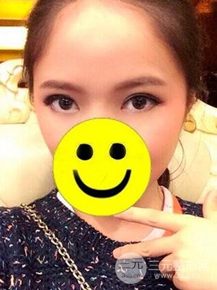 內(nèi)切祛眼袋手術(shù)真實(shí)案例，并附上前后對(duì)比圖片