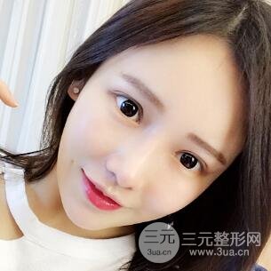 成都嬌點整容醫(yī)院李競做全臉脂肪填充案例