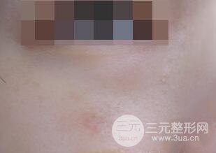 激光祛疤非手術(shù)真實果圖案例