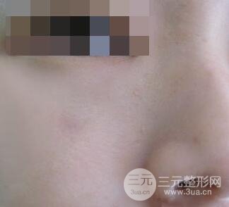 激光祛疤非手術(shù)真實果圖案例