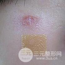 激光祛疤非手術(shù)真實(shí)果圖案例