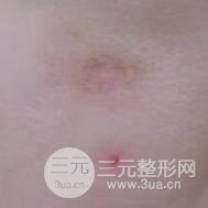 激光祛疤非手術(shù)真實(shí)果圖案例