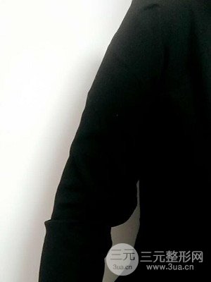 武漢天申朱天申醫(yī)生做的水動力吸脂瘦手臂，真實案例并附上前后對比圖