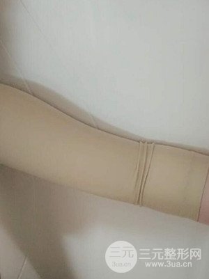 武漢天申朱天申醫(yī)生做的水動力吸脂瘦手臂，真實案例并附上前后對比圖