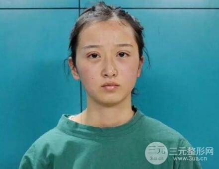 武漢天申朱天申切開雙眼皮真實案例，附上前后對比圖片