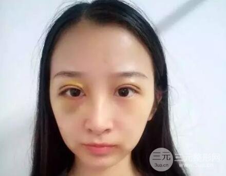 武漢天申朱天申切開雙眼皮真實案例，附上前后對比圖片