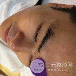 男士高強(qiáng)度聚焦超聲面b提升微整形真實(shí)案例