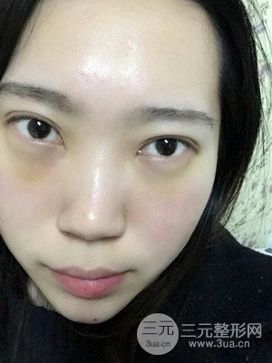 內(nèi)切祛眼袋手術(shù)真實(shí)案例，武漢天申胡麗醫(yī)生做的