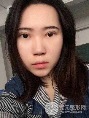 內(nèi)切祛眼袋手術(shù)真實(shí)案例，武漢天申胡麗醫(yī)生做的