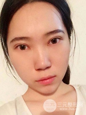 內(nèi)切祛眼袋手術(shù)真實(shí)案例，武漢天申胡麗醫(yī)生做的