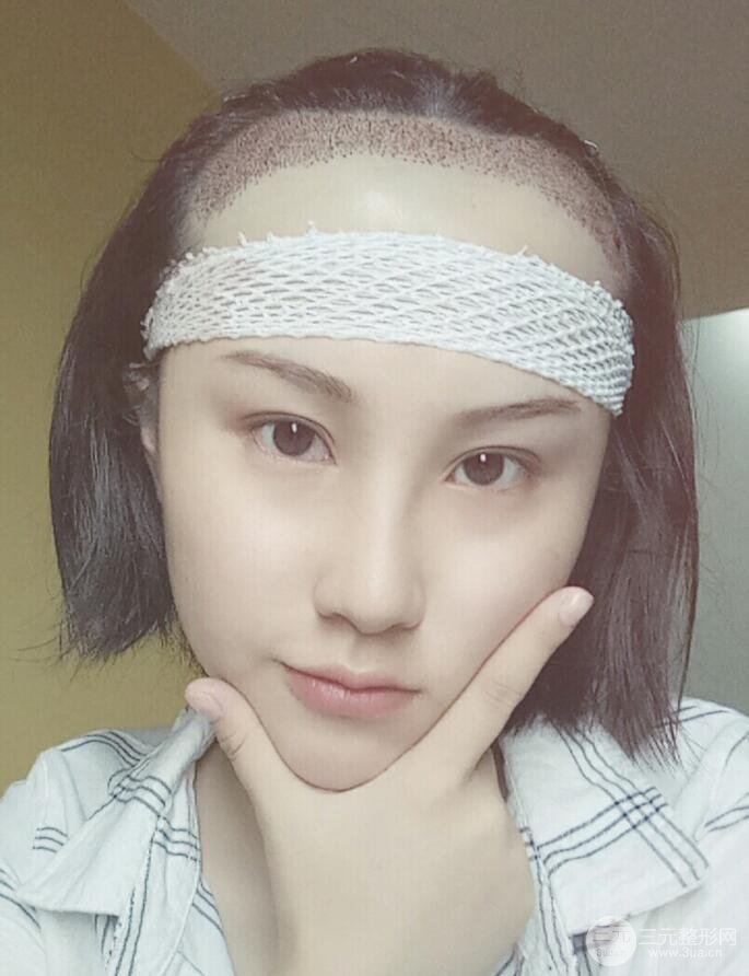 武漢天申胡麗醫(yī)生發(fā)際線種植真實(shí)案例，并附上前后對(duì)比圖片