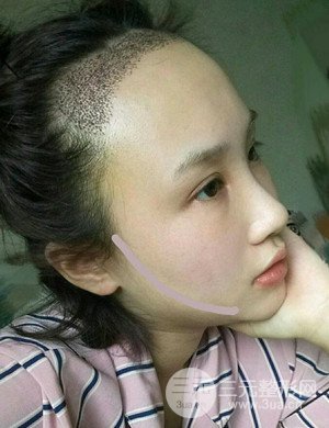 武漢天申胡麗醫(yī)生發(fā)際線種植真實(shí)案例，并附上前后對(duì)比圖片