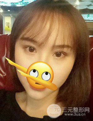 武漢天申胡麗醫(yī)生發(fā)際線種植真實(shí)案例，并附上前后對(duì)比圖片