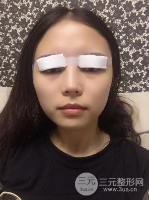 　全切雙眼皮真實案例分享，武漢一美汪國民醫(yī)生做的