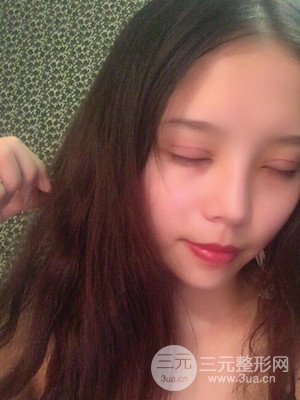 　全切雙眼皮真實案例分享，武漢一美汪國民醫(yī)生做的